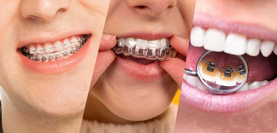 ارتودنسی نامرئی در رشت | اصلاح طرح لبخند در مطب دندانپزشکی دکتر دشت بزرگی