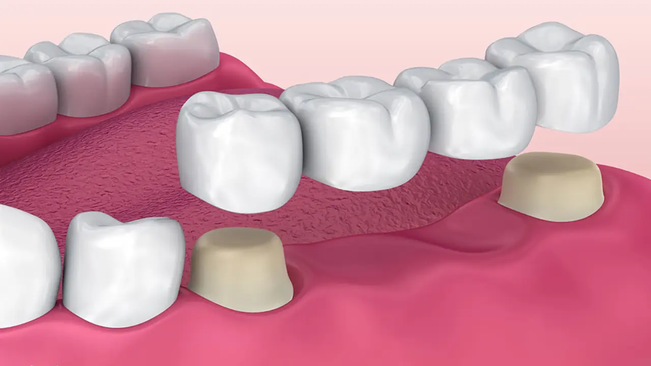 پل دندان یا بریج در رشت | راهنمای جامع مطب دندانپزشکی دکتر دشت بزرگی