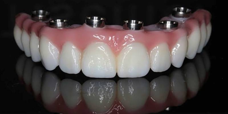 پروتز دندانی در رشت | جایگزینی دندانهای از دست رفته با دکتر دشت بزرگی