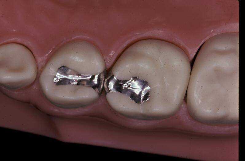 پر کردن دندان در رشت | ترمیم پوسیدگی با مواد با کیفیت مطب دکتر دشت بزرگی