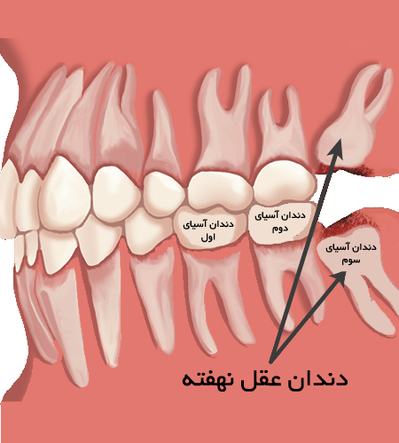 🦷 جراحی دندان عقل در رشت