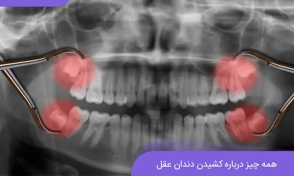 🦷 جراحی دندان عقل در رشت