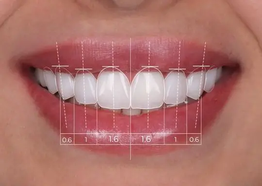 دندانپزشکی زیبایی در رشت؛ اصلاح طرح لبخند در مطب دکتر دشت بزرگی