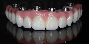 پروتز دندانی در رشت | جایگزینی دندان‌های از دست رفته با دکتر دشت بزرگی