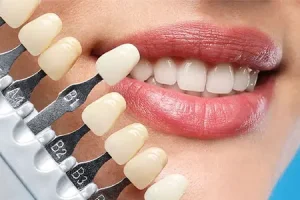 لمینت دندان در رشت | مزایا، مراقبت‌ها و هزینه در مطب دندانپزشکی دکتر دشت بزرگی