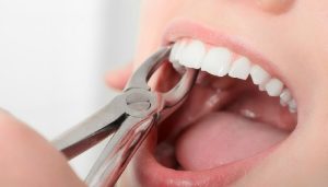 کشیدن دندان بدون درد در رشت | تجربه متفاوت در مطب دندانپزشکی دکتر دشت بزرگی